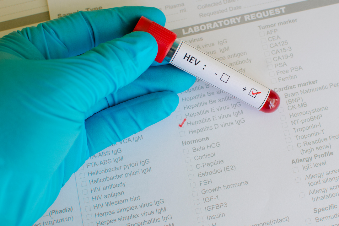 Le virus de l'hépatite E, un maître de la condensation génétique