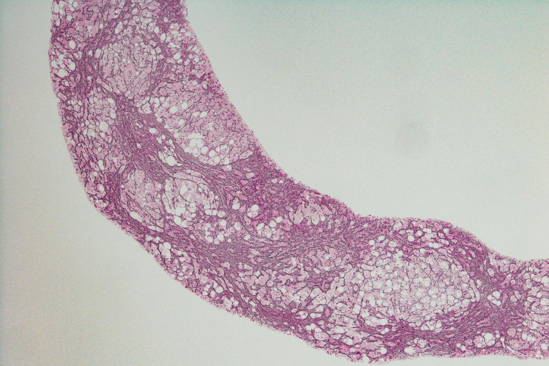 La stéatose hépatique : identification d’une nouvelle cible thérapeutique