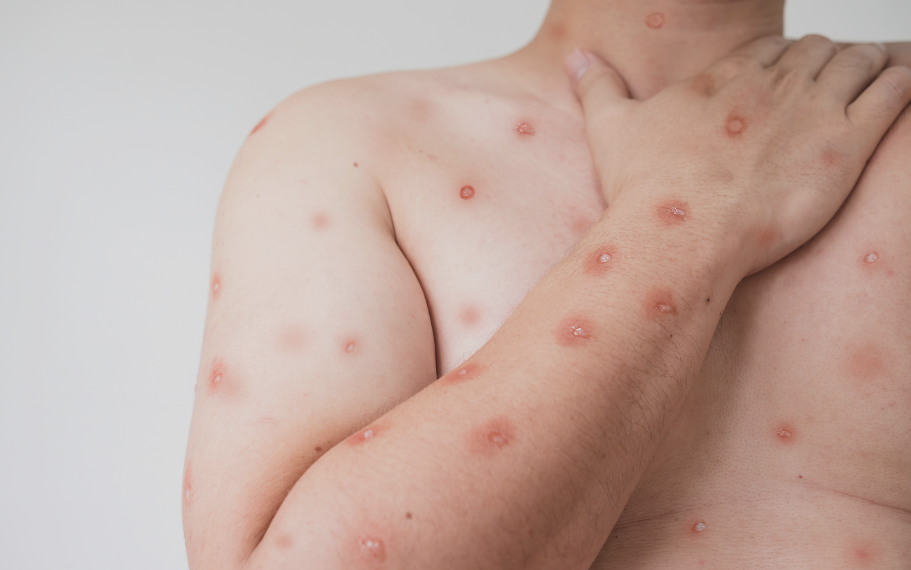 Mpox (variole du singe) : symptômes, transmission et traitements