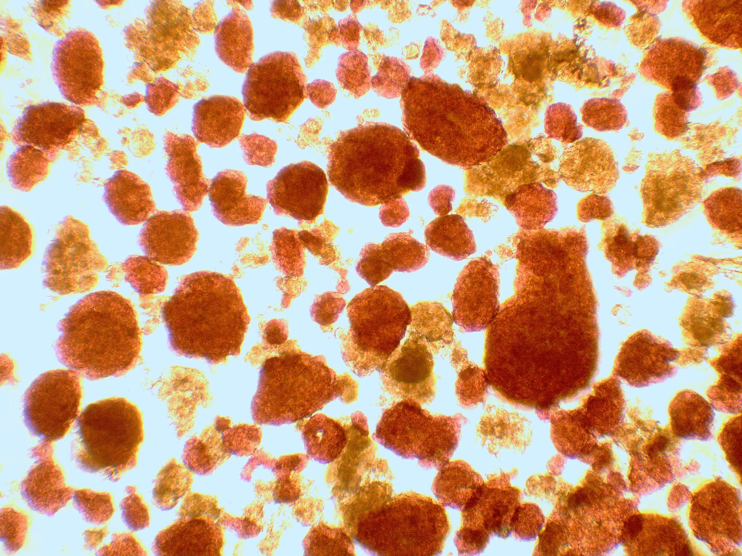 Une équipe Lilloise valide l’utilité de la greffe d’îlots pancréatiques chez des patients diabétiques de type 1 transplantés rénaux