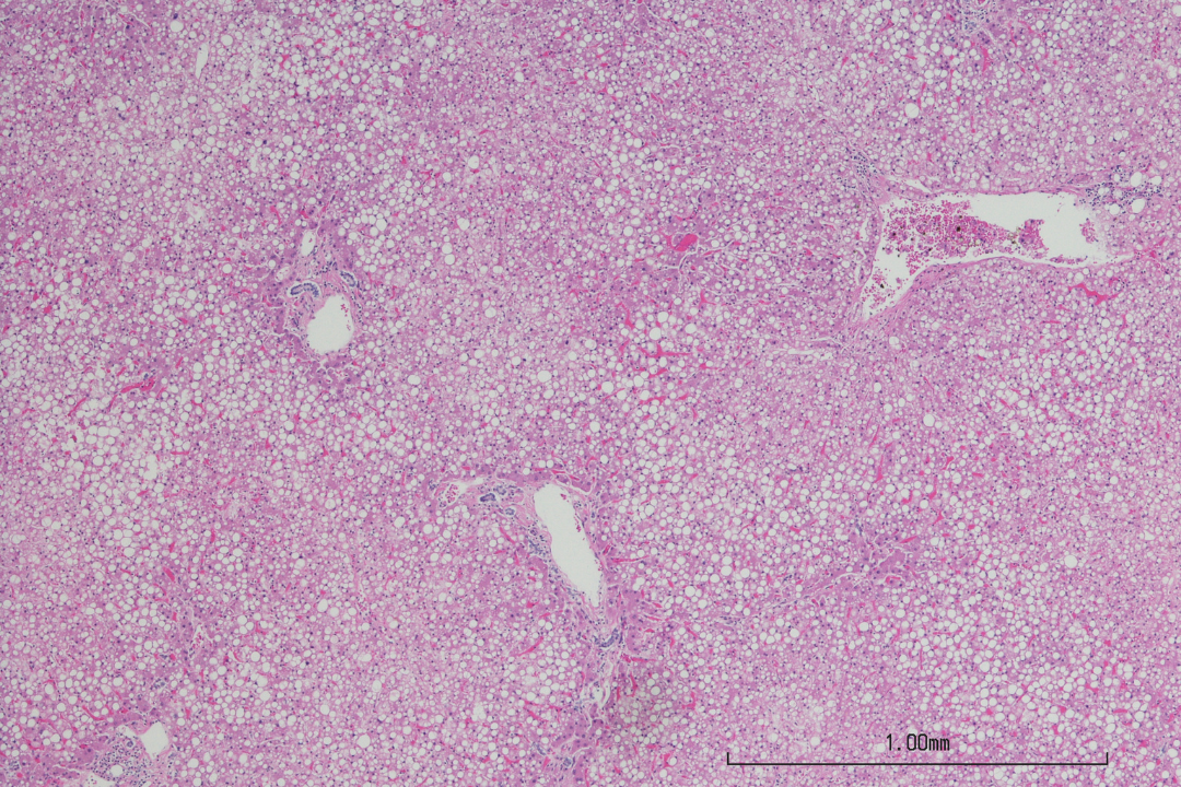 Stéatohépatite associée à un dysfonctionnement métabolique (MASH) : il n’existe pas un mais deux types de maladie