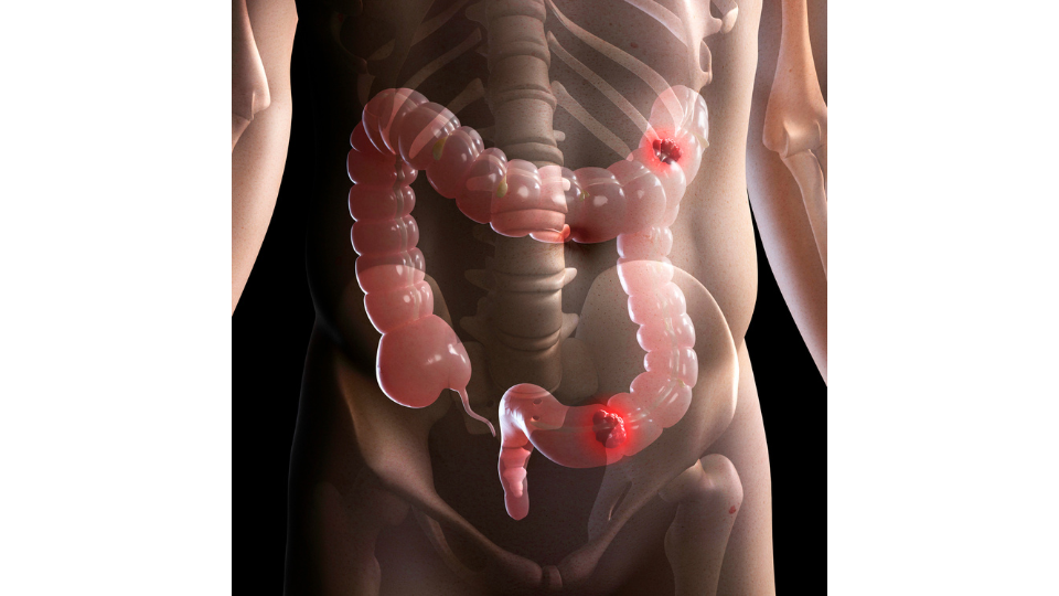 Cancer colorectal