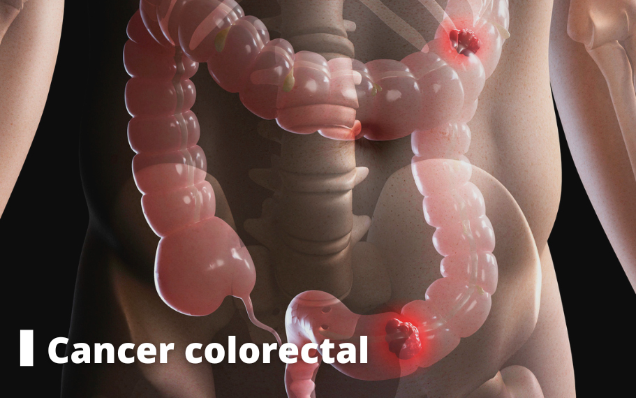 Cancer colorectal - Cancers dossier cancers pasteur lille