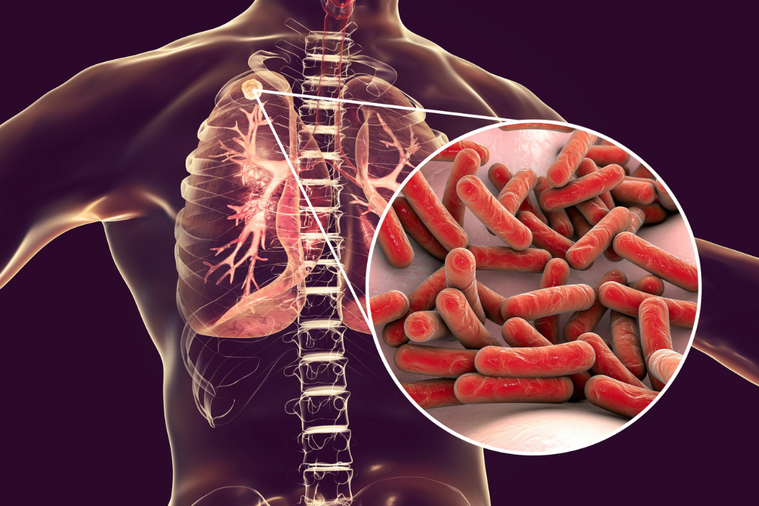 Lutte contre la tuberculose : un nouveau pas franchi pour un médicament développé à l'institut Pasteur de Lille