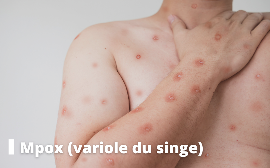 Mpox (variole du singe) Homme torse nu avec des boutons malade de la variole du singe mpox