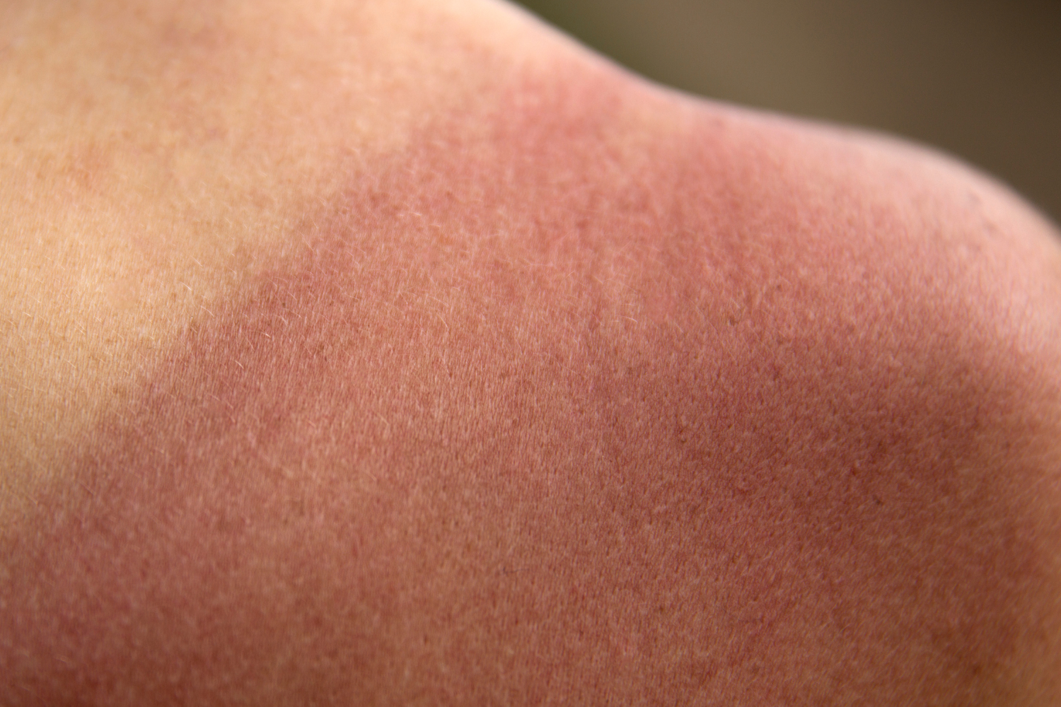 Peau rougie par un coup de soleil Coup de soleil sur l’épaule d’une personne après une exposition excessive aux UV