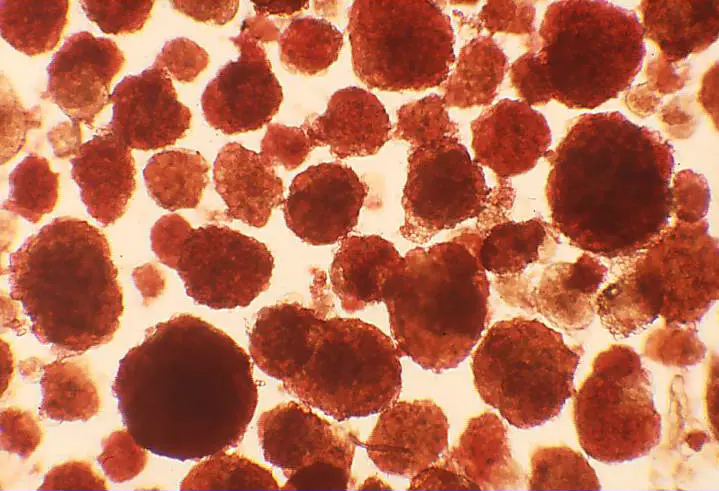 Diabète de type 1 : une avancée majeure dans la greffe d’îlots pancréatiques