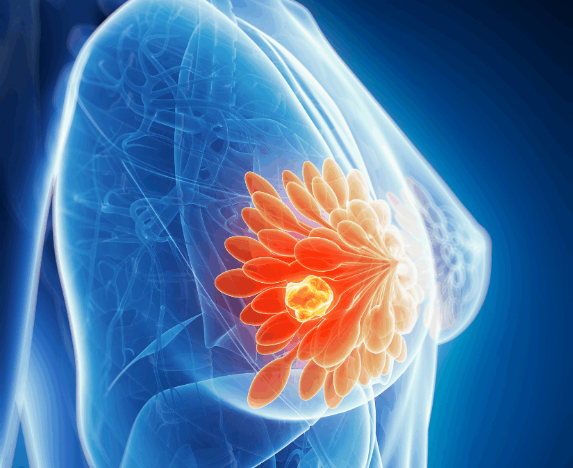 Sur le terrain de la recherche : le cancer du sein triple négatif