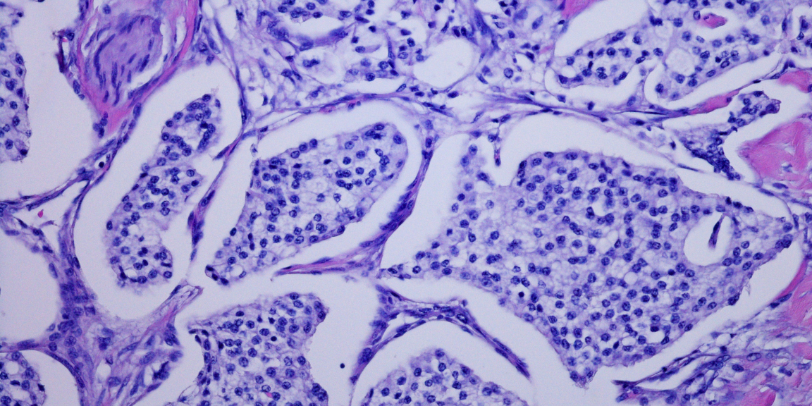 cancer neuroendrocrine