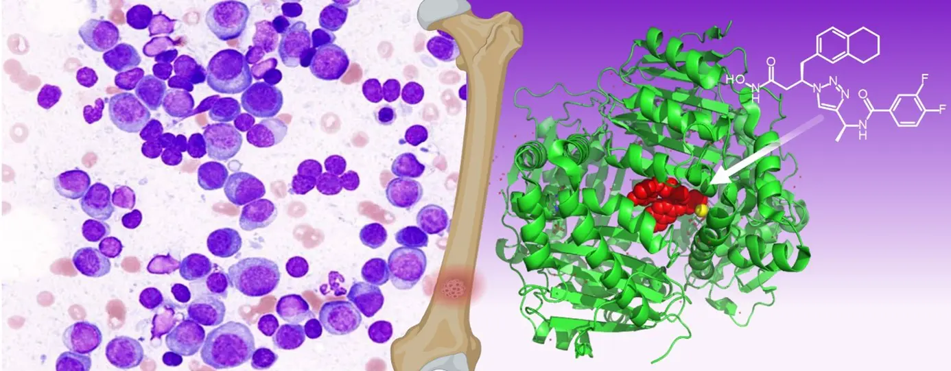 Insulin degrading enzyme emerges as a novel biomarker and therapeutic target in Multiple Myeloma.
