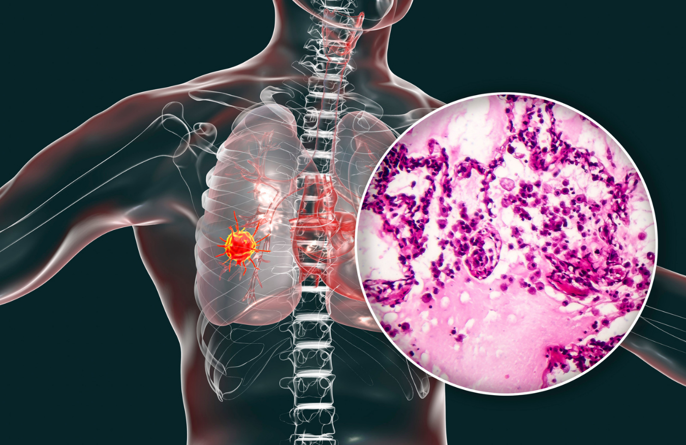 Une nouvelle stratégie thérapeutique pour réduire les séquelles associées aux pneumonies virales