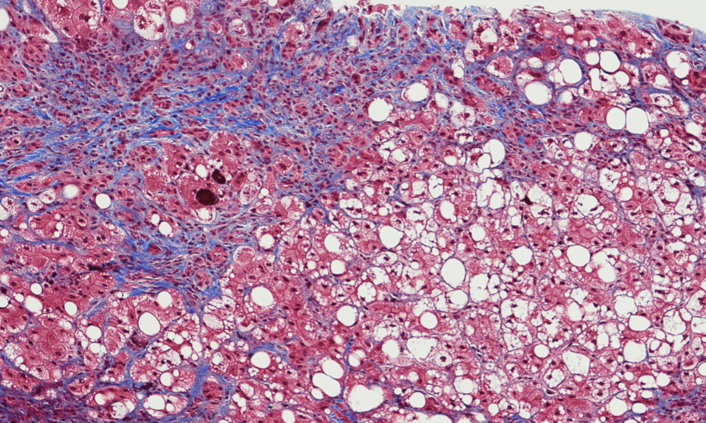 Image fibrose hépatique