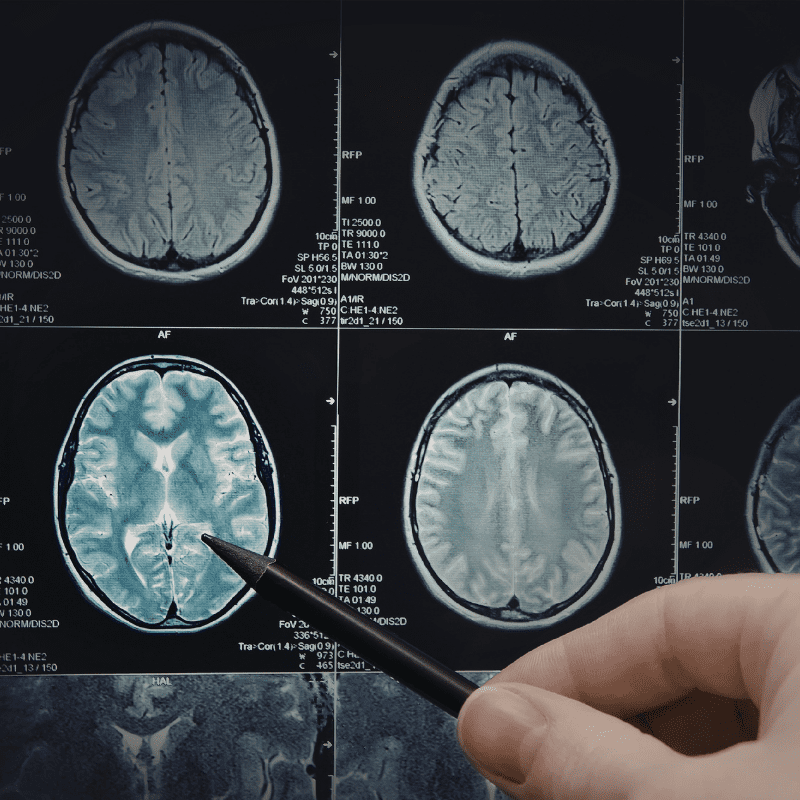 Une cartographie génétique inédite et élargie de la maladie d’Alzheimer